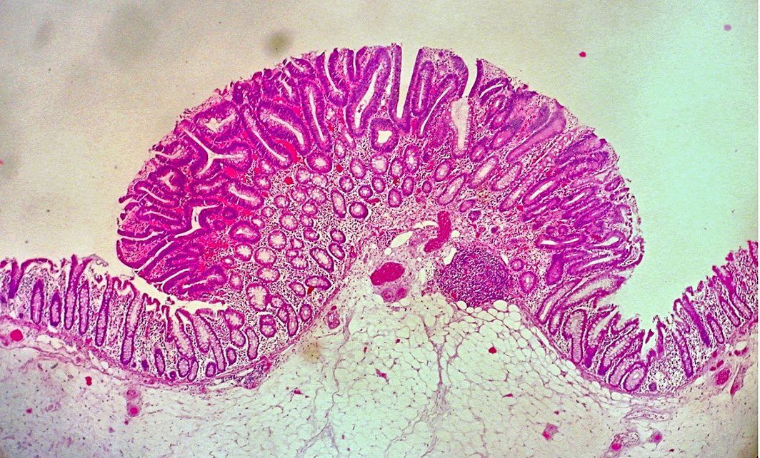 Adenoma tubular del colon al microscopio