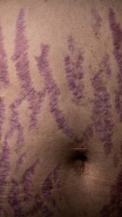Portada del video: Cara redonda, panza y estrías moradas: exceso de cortisol | SÍNDROME DE CUSHING