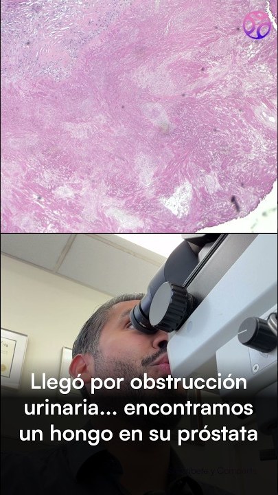 Portada del video: Llegó por obstrucción urinaria.. y encontramos un hongo en su próstata
