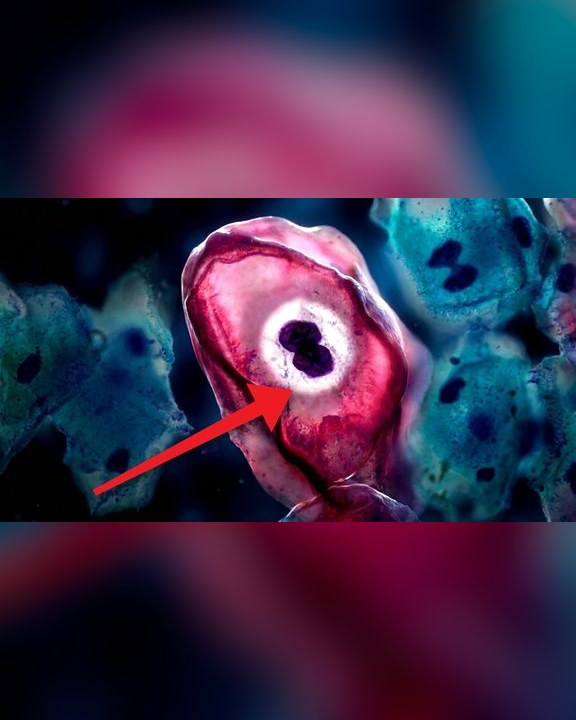 Portada del video: Preguntas por qué te dio el papiloma humano... casi todos lo van a tener | VPH