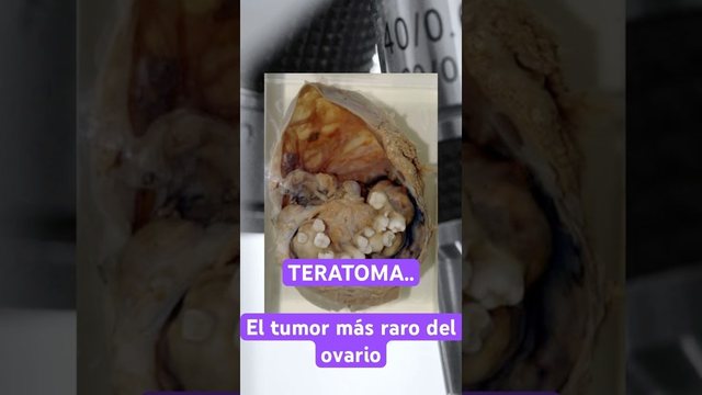 Miniatura del video: El tumor más extraño del ovario