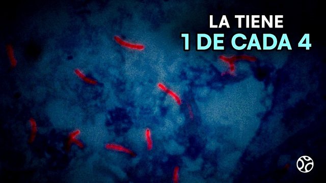 Miniatura del video: Tuberculosis: creyó que su tos era EPOC.. lo confirmamos al microscopio