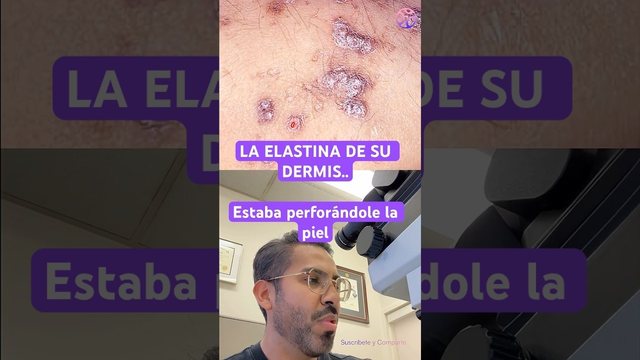 Miniatura del video: Su piel le estaba gritando que sus riñones estaban fallando 🔬