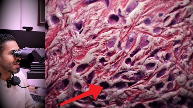 Portada del video: Pensaron que era inflamación en la piel... era su cáncer de mama | CARCINOMA LOBULAR