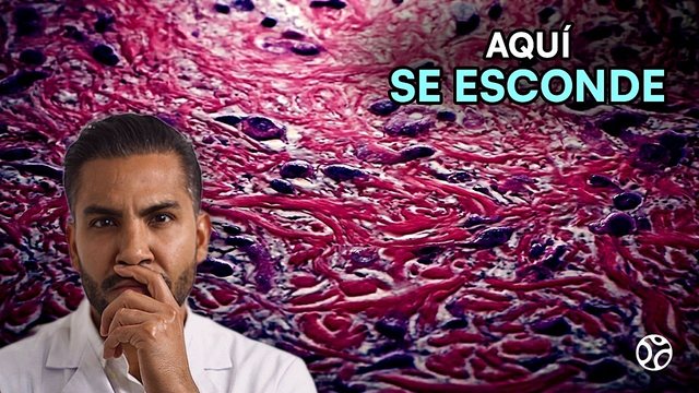 Miniatura del video: Pensaron que era inflamación en la piel... era su cáncer de mama | CARCINOMA LOBULAR