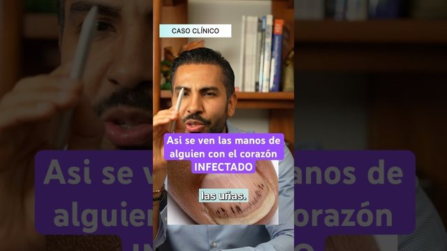 Miniatura del video: Asi se ven las manos de un paciente con una infeccion en el corazon