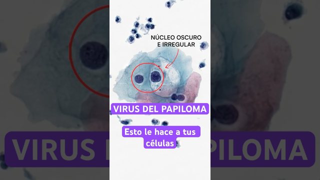 Miniatura del video: VPH.. asi se ve infectando tus células..