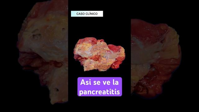 Miniatura del video: Pancreatitis aguda.. asi se ve un pancreas que se digiere a si mismo