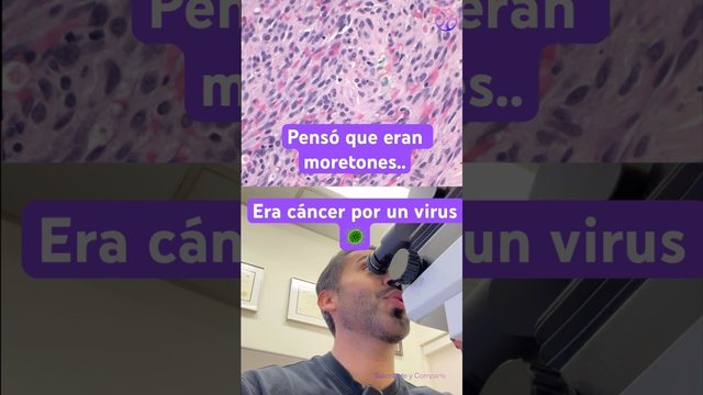 Miniatura del video: Pensó que eran moretones... era cáncer por un virus 🦠🔬