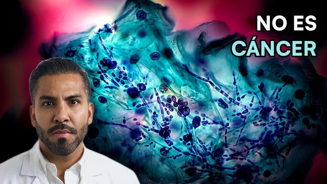 Miniatura del video: El Papanicolaou no solo busca cáncer... ahí salen herpes, candida y tricomonas | CITOLOGÍA CERVICAL
