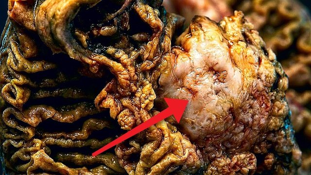 Portada del video: Cáncer de páncreas: la pastilla que por fin dobló la supervivencia