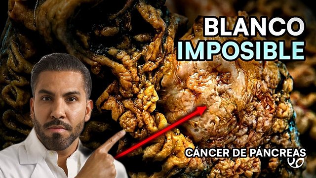 Miniatura del video: Cáncer de páncreas: la pastilla que por fin dobló la supervivencia