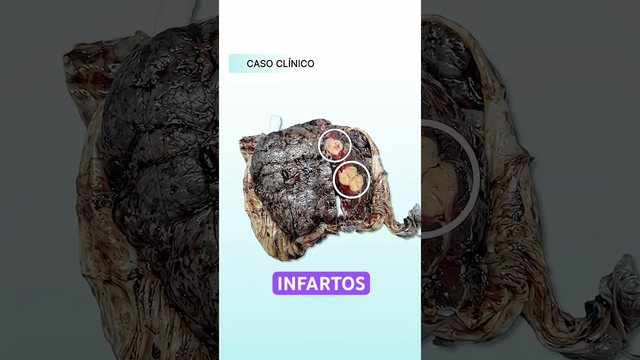Miniatura del video: Esta placenta tiene infartos.. así funciona la preeclampsia por dentro