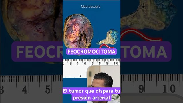 Portada del video: Pheochromocytoma Final