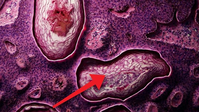 Portada del video: Creyó que era melanoma... era la lesión más común de la piel | QUERATOSIS SEBORREICA