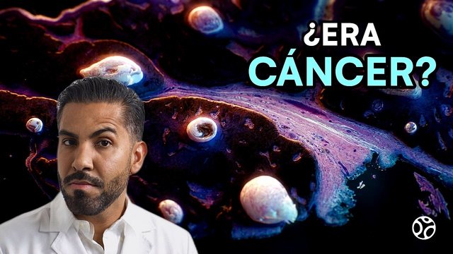 Miniatura del video: Creyó que era melanoma... era la lesión más común de la piel | QUERATOSIS SEBORREICA