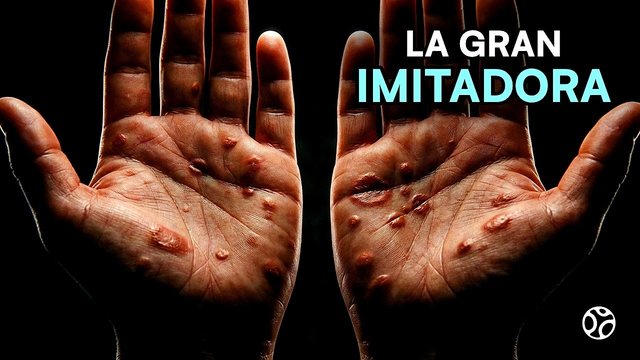 Miniatura del video: Creyó que se curó... la sífilis le brotó en manos, pies y lengua