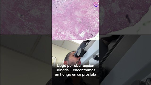 Miniatura del video: Llegó por obstrucción urinaria.. y encontramos un hongo en su próstata