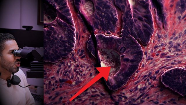 Portada del video: Llegó por dolor abdominal... el tumor del hígado venía de su colon | CÁNCER METASTÁSICO