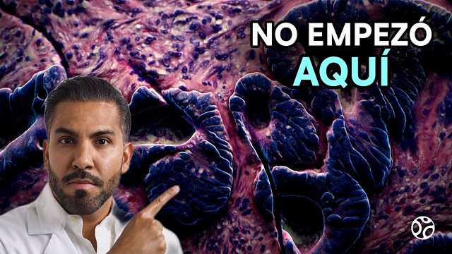 Miniatura del video: Llegó por dolor abdominal... el tumor del hígado venía de su colon | CÁNCER METASTÁSICO