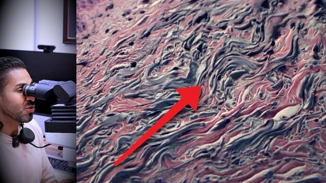 Portada del video: Años de sol sin sentir nada... su piel ya se estaba volviendo cáncer | QUERATOSIS ACTÍNICA
