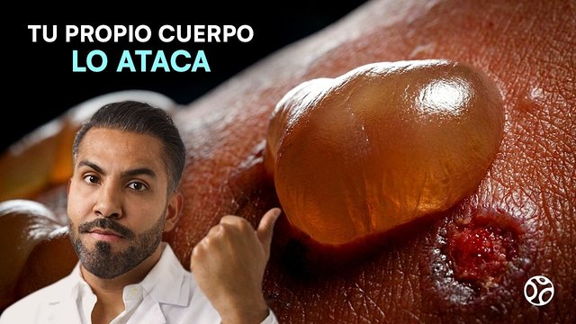 Miniatura del video: Pensaban que era alergia... sus anticuerpos le despegaron la piel | PENFIGOIDE AMPOLLOSO
