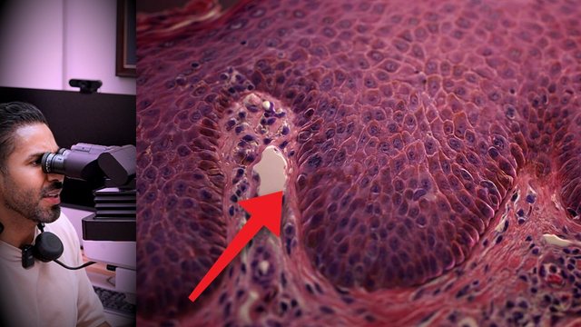 Portada del video: Piensan que la psoriasis se contagia... sus defensas le atacan la piel