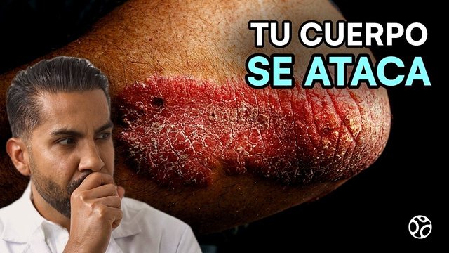 Miniatura del video: Piensan que la psoriasis se contagia... sus defensas le atacan la piel