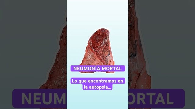 Miniatura del video: NEUMONÍA MORTAL — Lo que encontramos en la autopsia
