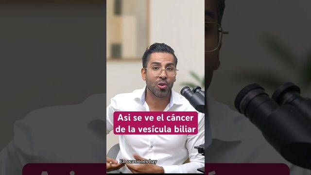 Miniatura del video: 🔬 Así se ve el cáncer de vesícula biliar.