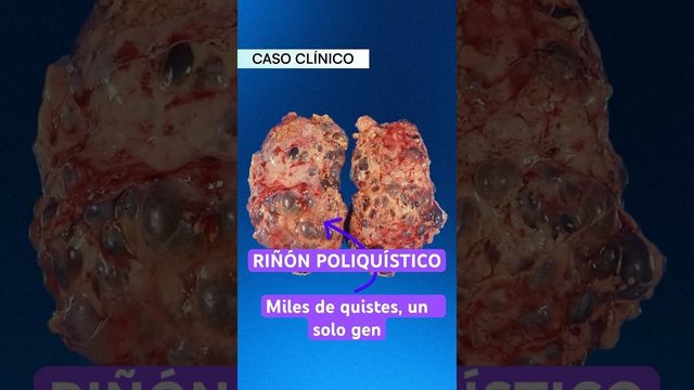 Miniatura del video: Tus riñones pueden llegar a pesar 10 KILOS 🔬#medicina #doctor #cancer #riñon