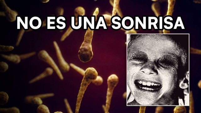 Portada del video: Tétanos: la sonrisa que ningún médico quiere ver