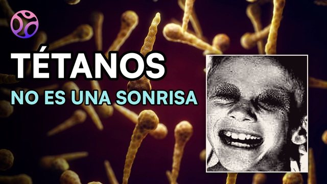 Miniatura del video: Tétanos: la sonrisa que ningún médico quiere ver