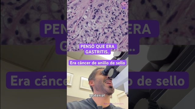 Miniatura del video: Pensó que era gastritis... era cáncer de anillo de sello 💍🔬