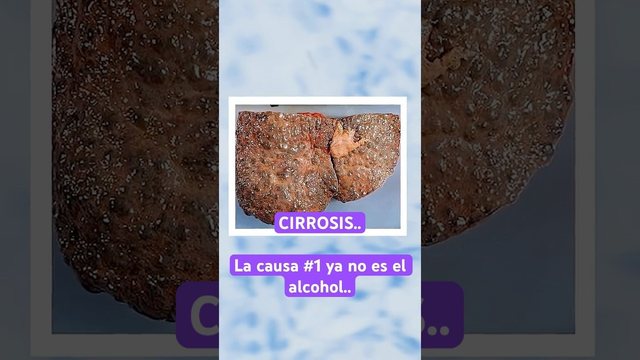 Miniatura del video: CIRROSIS - La primera causa YA NO es el alcohol.