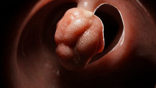 Portada del video: Fue a una colonoscopia sin síntomas... y le encontraron esto | PÓLIPO EN EL COLON