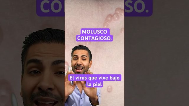 Miniatura del video: Molusco contagioso, el virus que se esconde en la piel