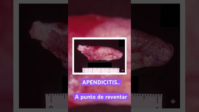 Miniatura del video: Esto es un apéndice a punto de reventar #apendicitis #apendice #inflamacion #patologia