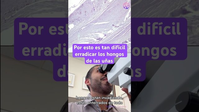 Miniatura del video: Hongos en las uñas: así los diagnosticamos