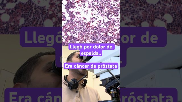 Miniatura del video: El cáncer de próstata le viajó hasta las vértebras ..