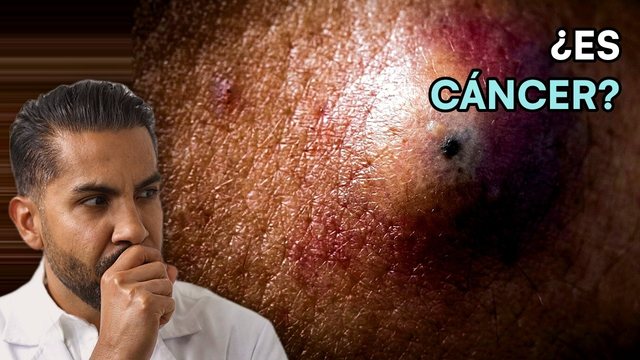 Miniatura del video: Llegó aterrado por un cáncer de piel... era un poro tapado | QUISTE EPIDERMOIDE