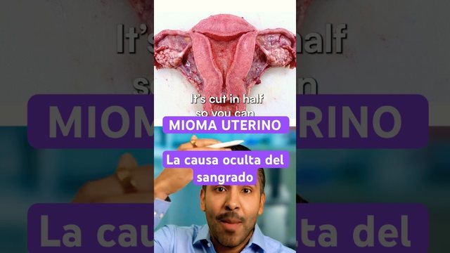 Miniatura del video: MIOMA UTERINO - El caso oculto del sangrado