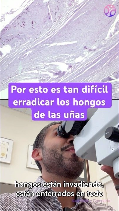Portada del video: Hongos en las uñas: así los diagnosticamos